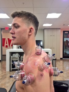 Meyers Leonard receiving  cupping, which is a Traditional Chinese Medicine technique 